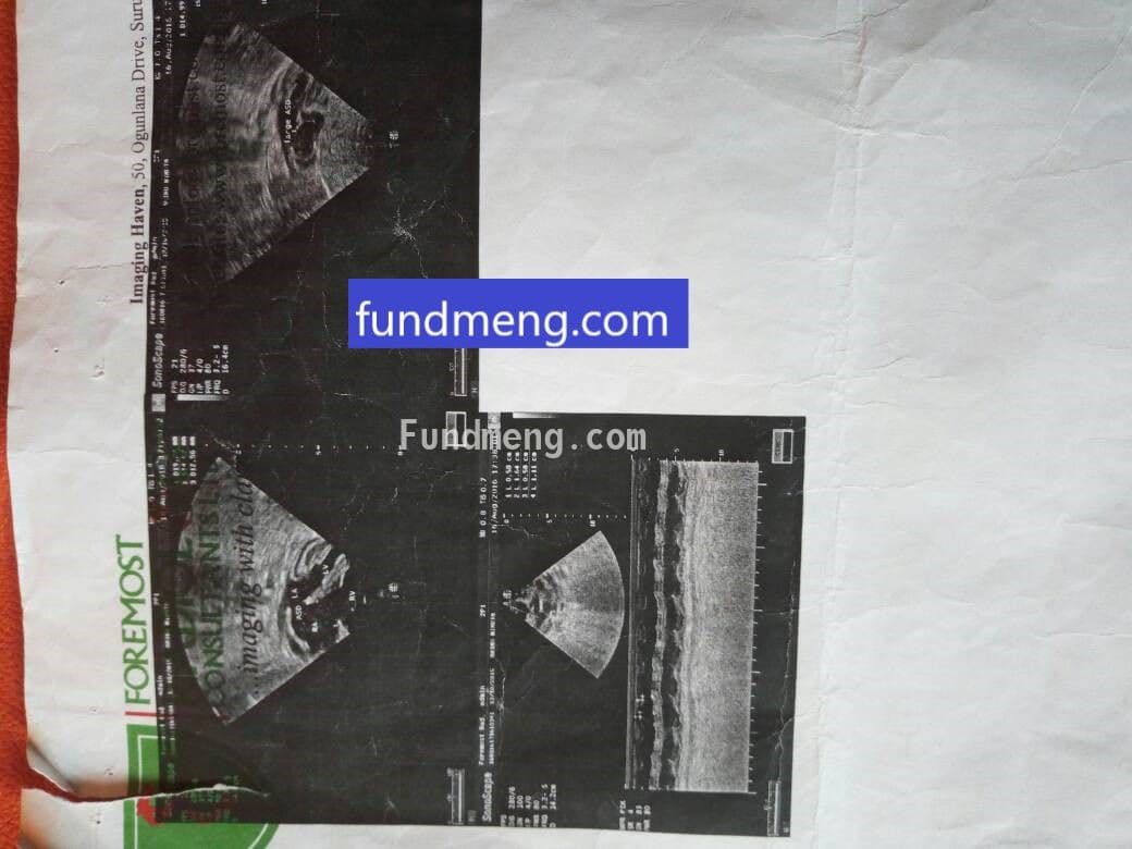 2 year old baby Ola Aminu has a hole in her heart, she needs your help to live