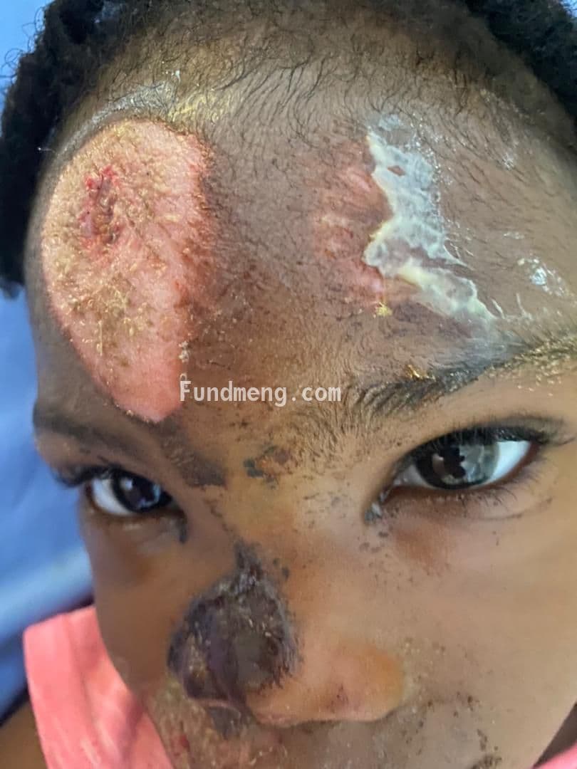 4 years old Sonia Nnadozie Utah to walk normally again