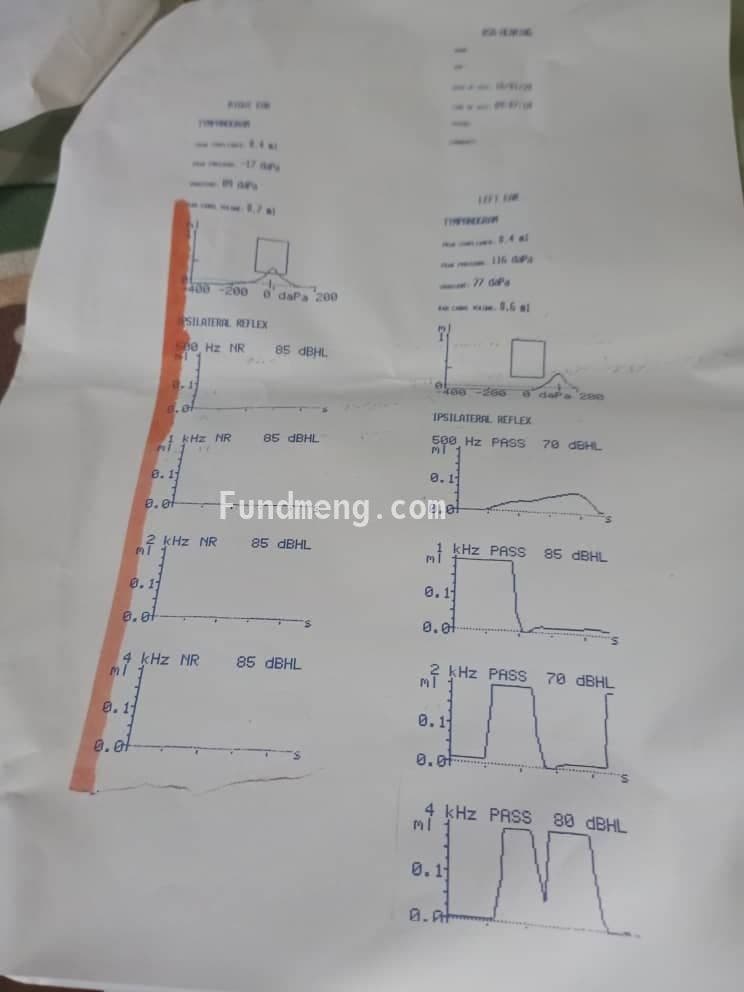 Asa needs a Cochlear Implant via Surgery