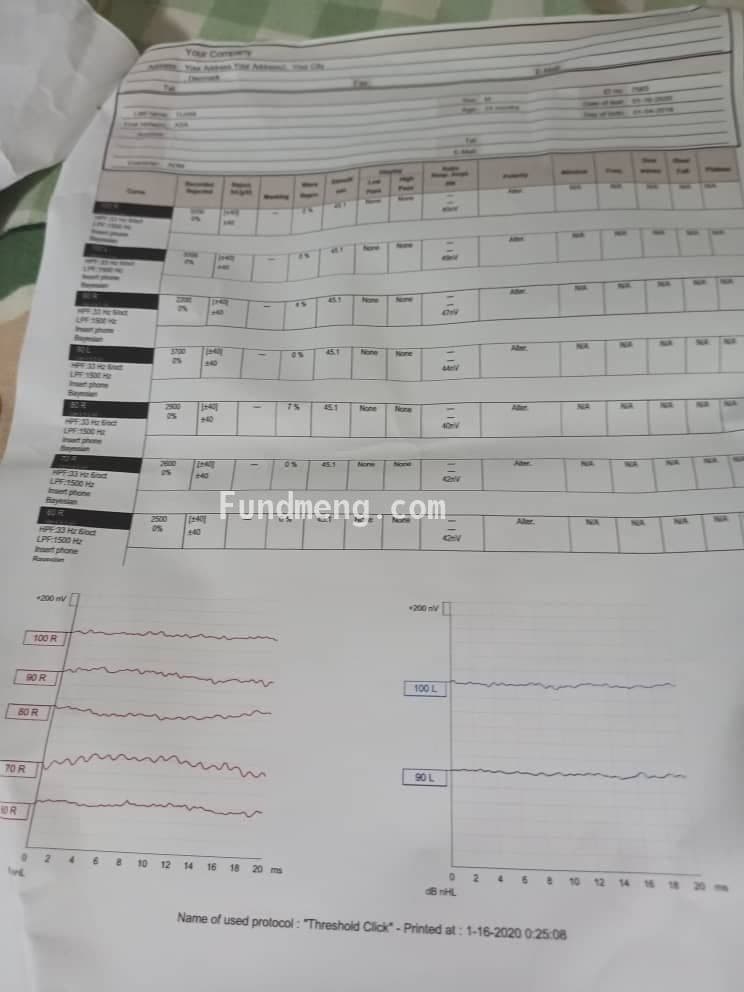Asa needs a Cochlear Implant via Surgery