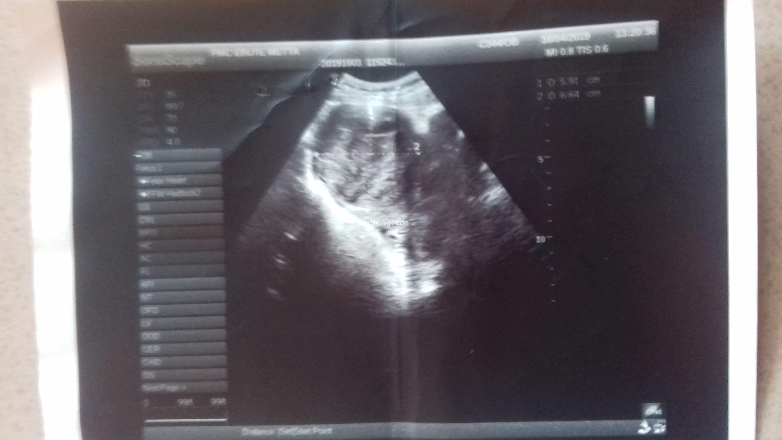 Help Odinakachi Umeizu fight against Uterine Fibroid