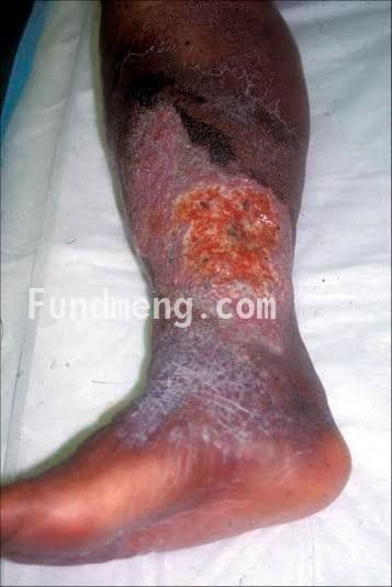 Help Uduak Effiong fight chronic Ulcer
