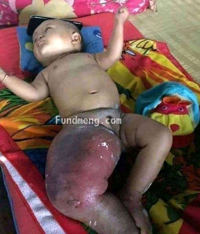 Help Gideon's leg tumor