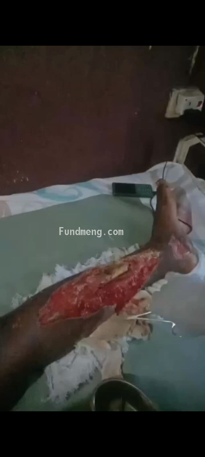 Help Godswill Arianne,an accident victim who needs money for his surgery to be done