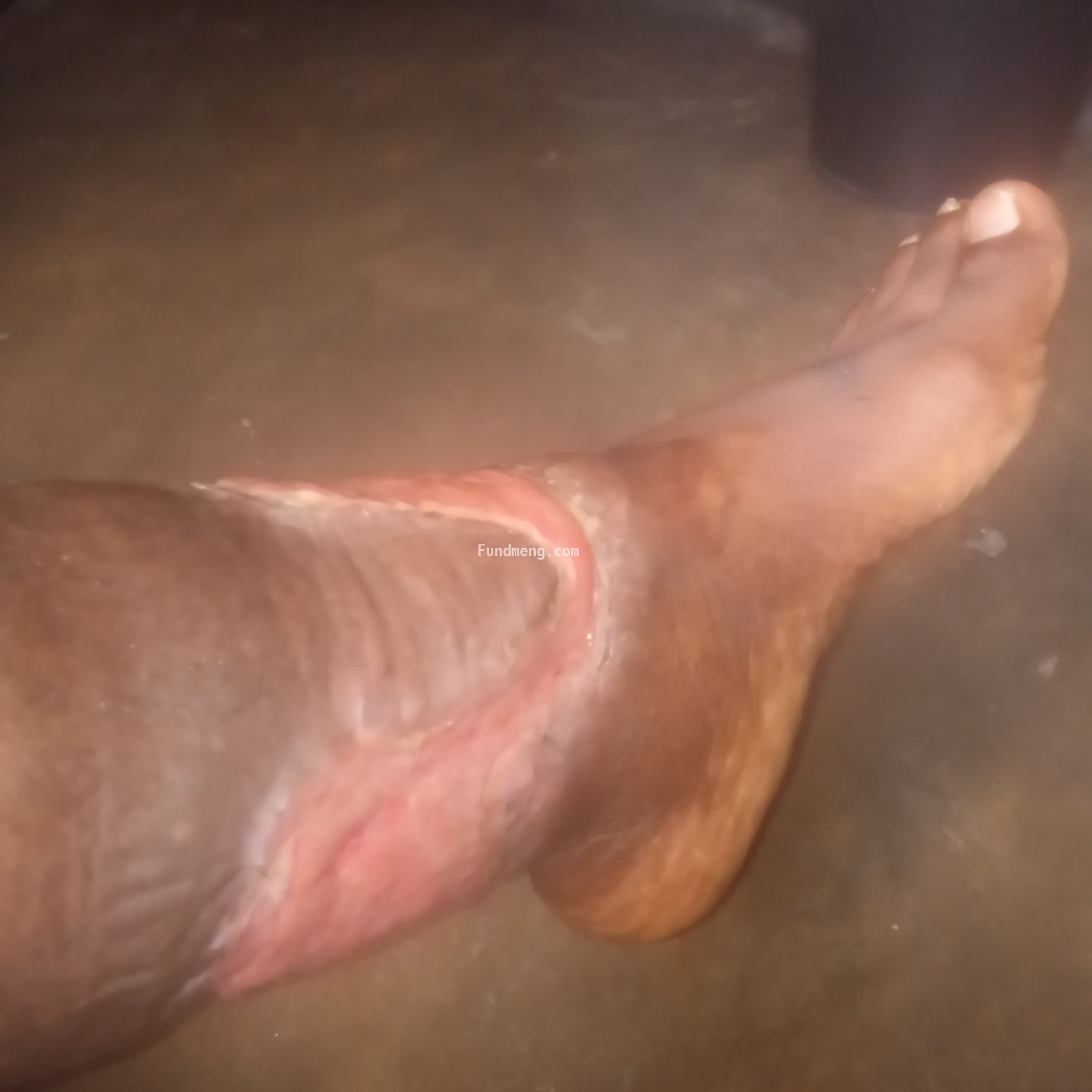 Please help Innocent Jesse  treat chronic leg ulcer