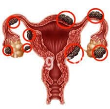 Help me pay for my Hysterectomy operation