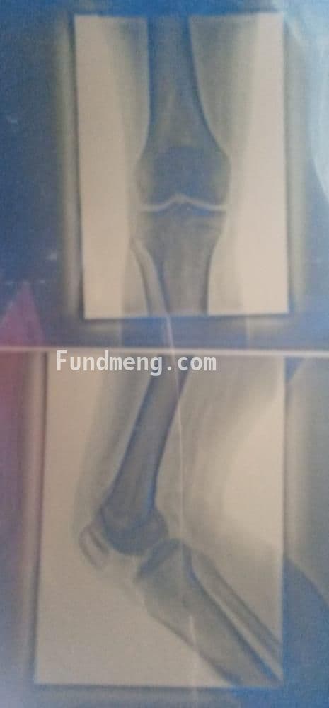 Please help dauda emmanuel for his knee surgery so he can start playing football again thanks as you do and God bless you.