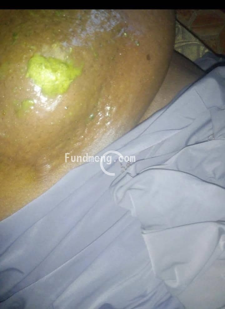 Help Halimat zakariyyah beat cancer, she was diagnosed of early breast cancer and need 3 series of chemotherapy, 2 has been done, 1 more to go sum of #950,000 is needed for the treatment