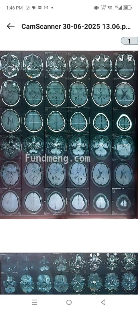 Urgent Medical Support for My Father's Brain Surgery